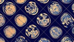 8 hábitos sencillos que reducen el riesgo de Alzheimer y otras formas demencia, según estudios recientes